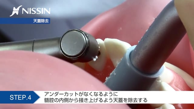 第10章 歯内療法修復：髄室開拡の基本（上顎中切歯）