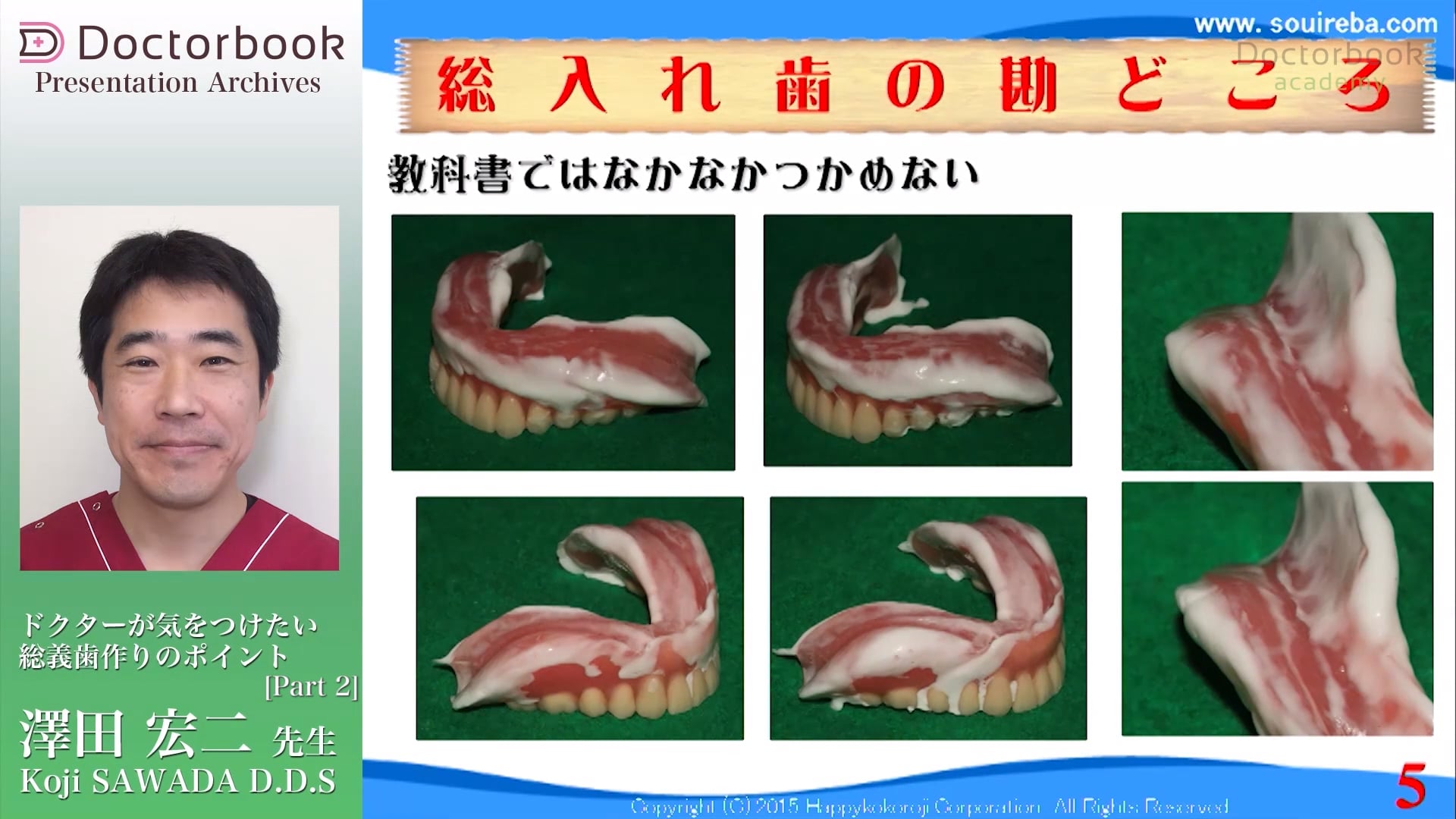 #1 総義歯の困難度タイプ分け