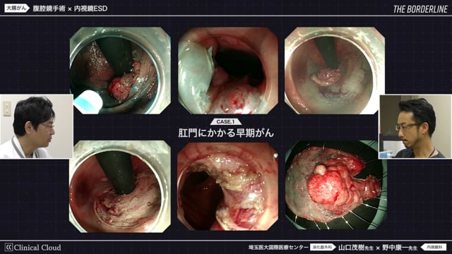THE BORDERLINE #1 part1 大腸がんにおける外科的治療と内視鏡治療の境界