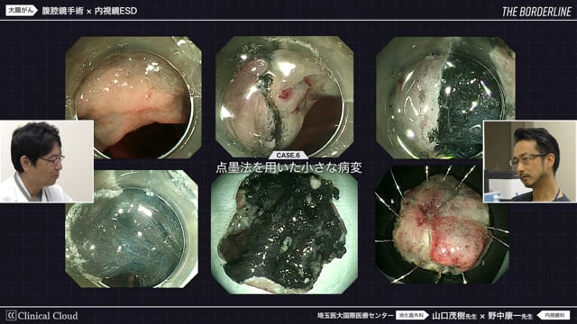 THE BORDERLINE #1 part3 大腸がんにおける外科的治療と内視鏡治療の境界