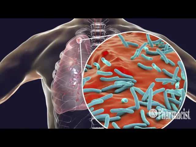 Who Does Tuberculosis Affect Pulmonary