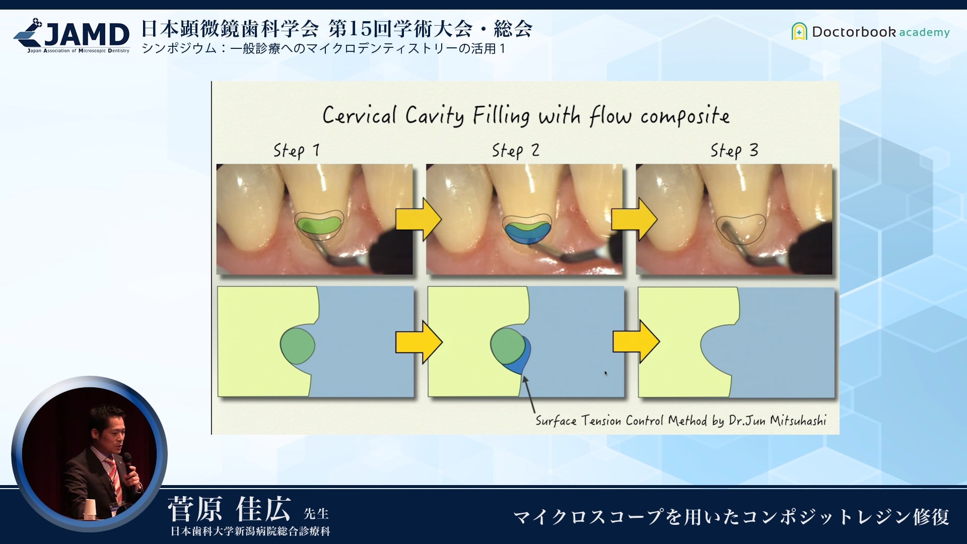 マイクロスコープを用いたコンポジットレジン修復