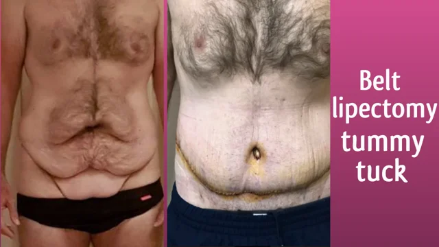 Belt Lipectomy Surgery After Weight Loss on Vimeo