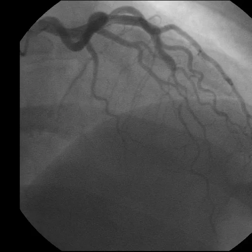Video 7.8.1. Coronary angiography revealed a long length of diffuse mid ...