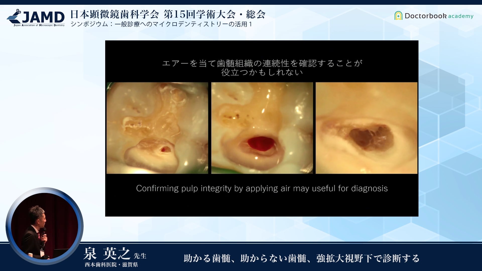 助かる歯髄、助からない歯髄、強拡大視野下で診断する