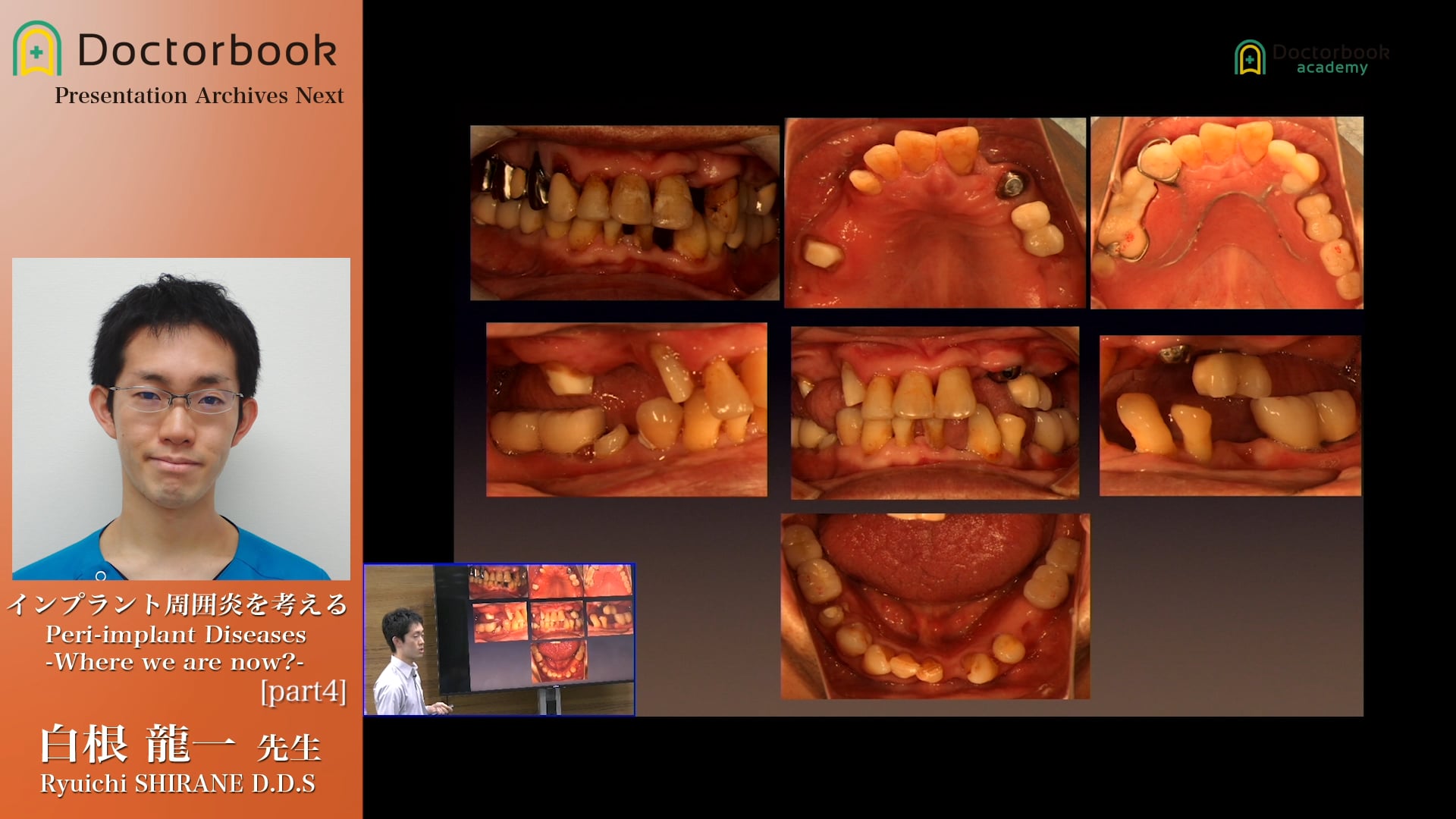 #4 歯周病重篤度とインプラント治療後問題発生率