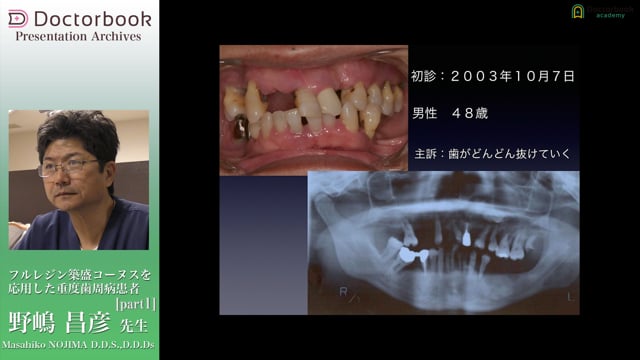 フルレジン築盛コーヌスを応用した重度歯周病患者