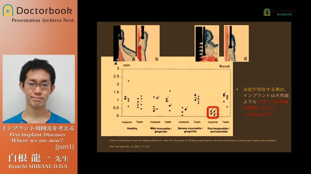 インプラント周囲炎を考える Peri-implant Diseases -Where we are now?-