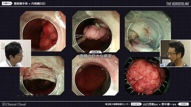 THE BORDERLINE #1 part2 大腸がんにおける外科的治療と内視鏡治療の境界