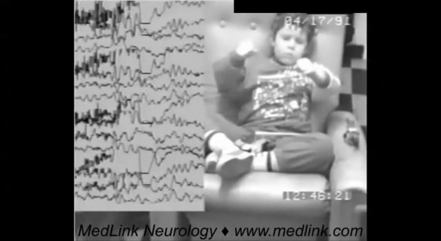 Myoclonic absence seizures of a boy with normal development (idiopathic)
