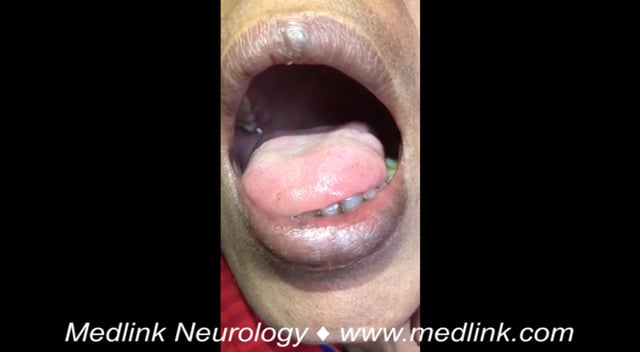 Tongue fasciculations