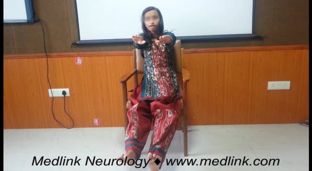 Subacute sclerosing panencephalitis: subtle myoclonus (1)
