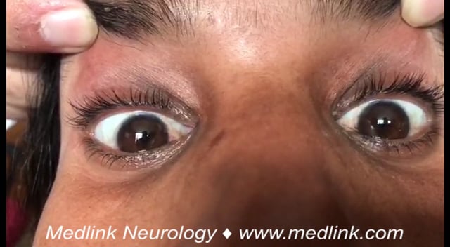 Downbeat nystagmus