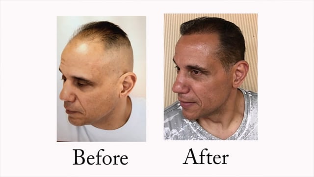 Hair Transplant Testimonial - New Jersey