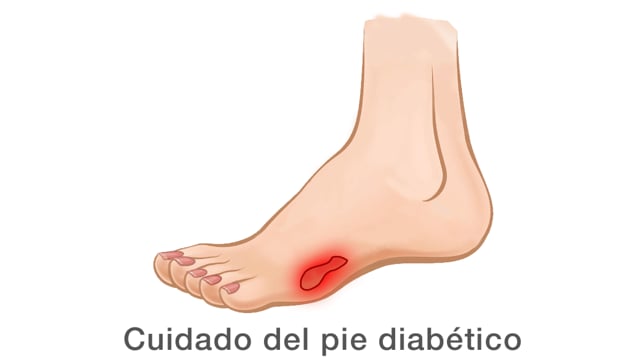 Cuidado del pie diabético