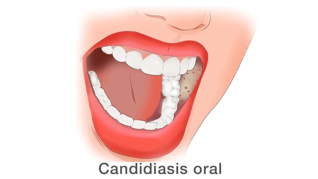 Candidiasis oral