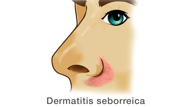 Dermatitis seborreica