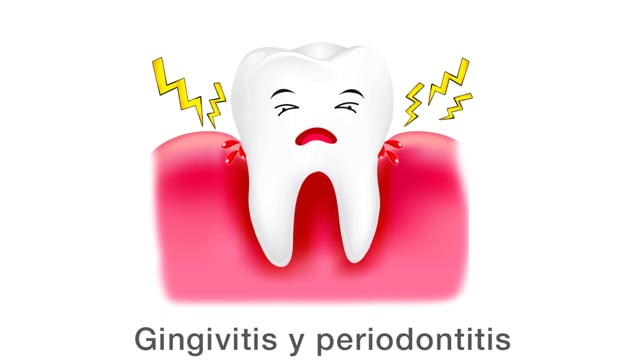 Gingivitis y periodontitis