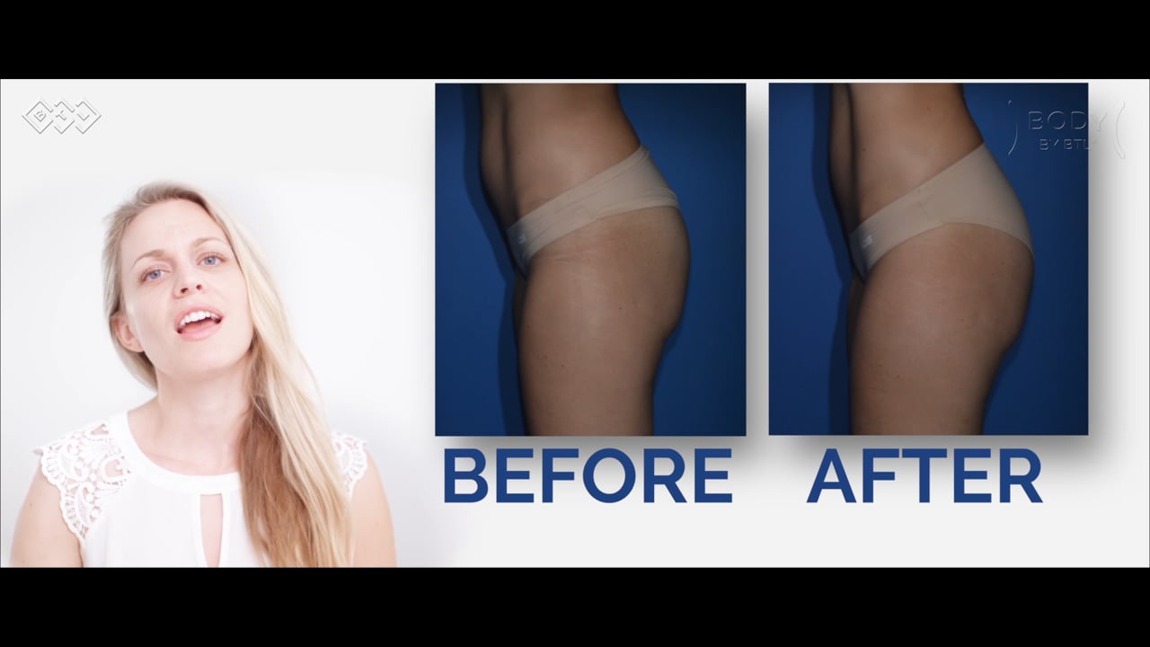 Patient Testimonial emsculpt buttocks