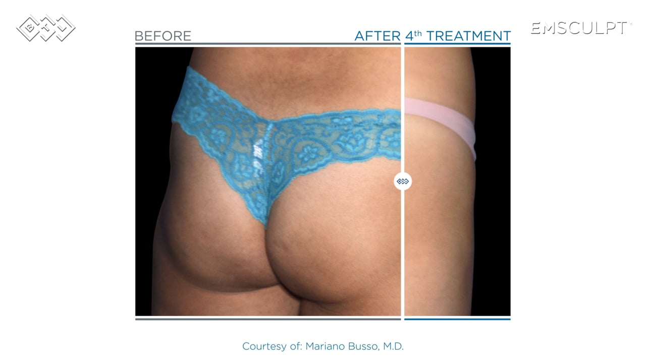 5 Possible Results From EMSCULPT Treatment, by ALLURE LASER STUDIO