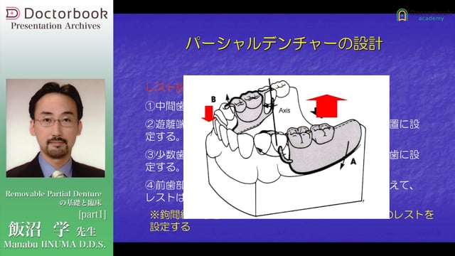 Removable Partial Dentureの基礎と臨床