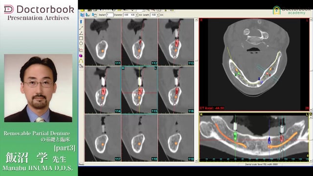 Removable Partial Dentureの基礎と臨床 | Doctorbook academy ...