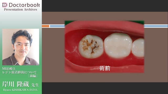 MI治療とレジン接着修復について