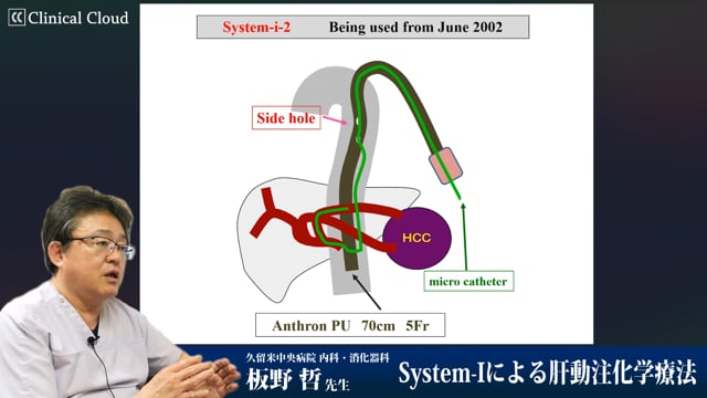 System-iによる肝動注化学療法