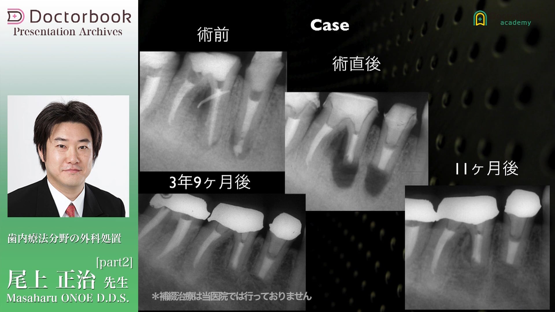 #2 従来型歯根端切除術とマイクロサージェリーの成功率の差