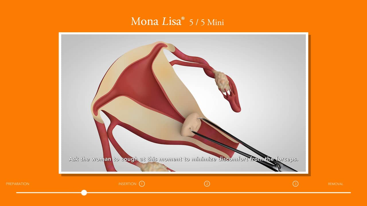 Insertion directions for Mona Lisa IUD NTCu380 on Vimeo