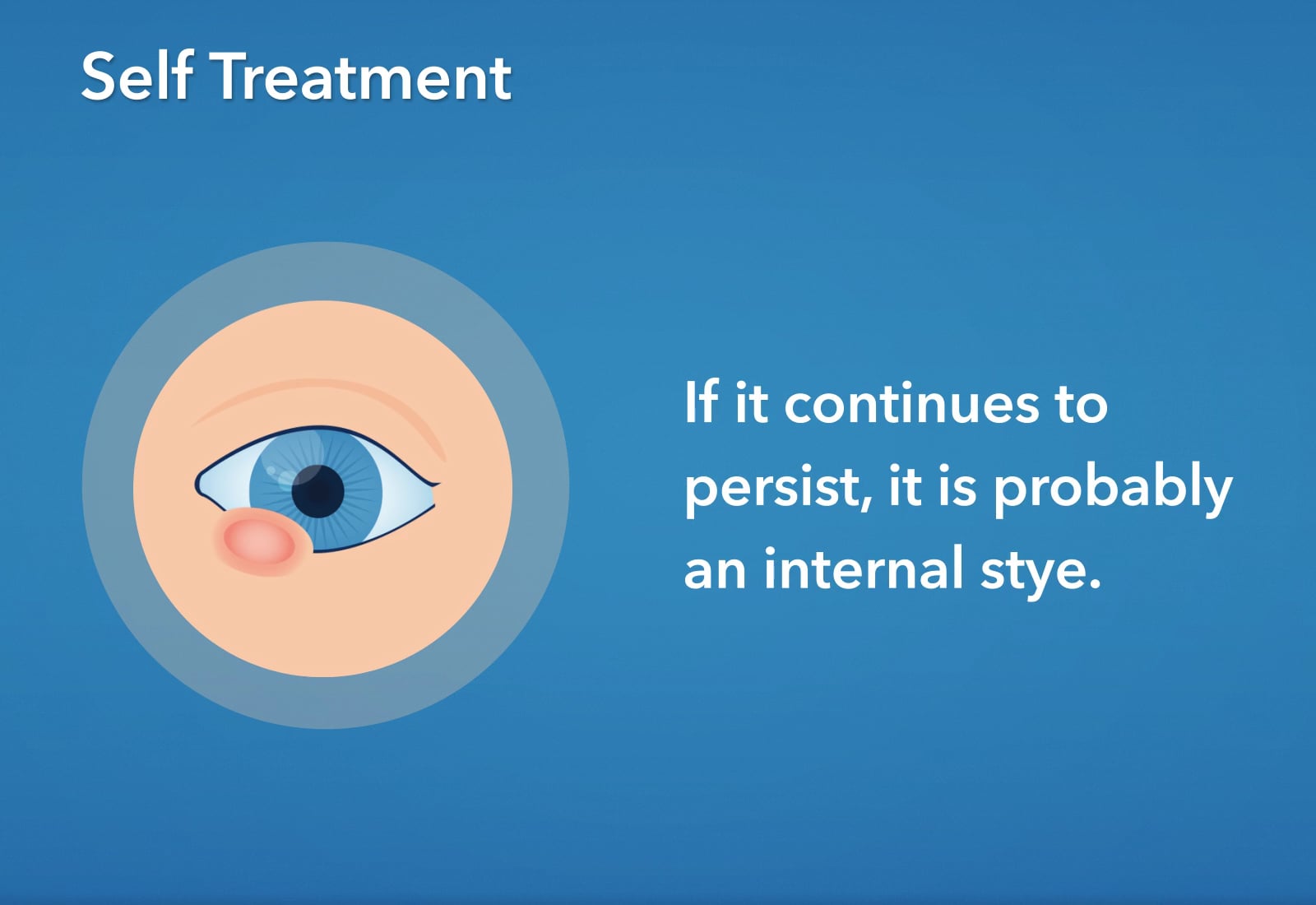 Stye - Self Treatment on Vimeo