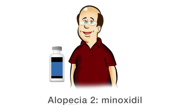 Alopecia 2: minoxidil