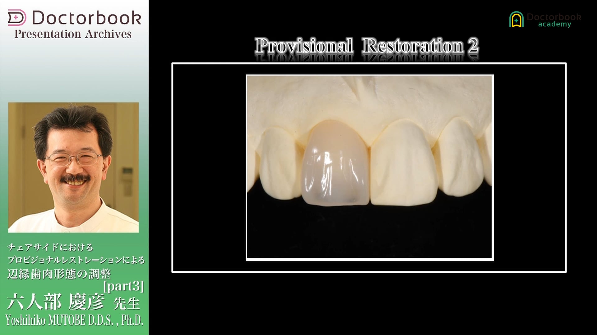 チェアサイドにおけるプロビジョナルレストレーションによる辺縁歯肉形態の調整 #3