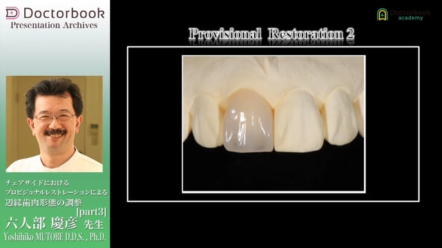チェアサイドにおけるプロビジョナルレストレーションによる辺縁歯肉形態の調整 #3