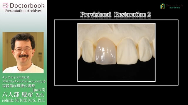 チェアサイドにおけるプロビジョナルレストレーションによる辺縁歯肉形態の調整 #3