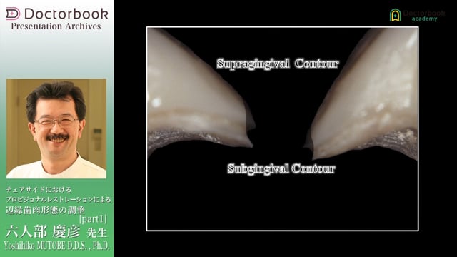 チェアサイドにおけるプロビジョナルレストレーションによる辺縁歯肉形態の調整 #1