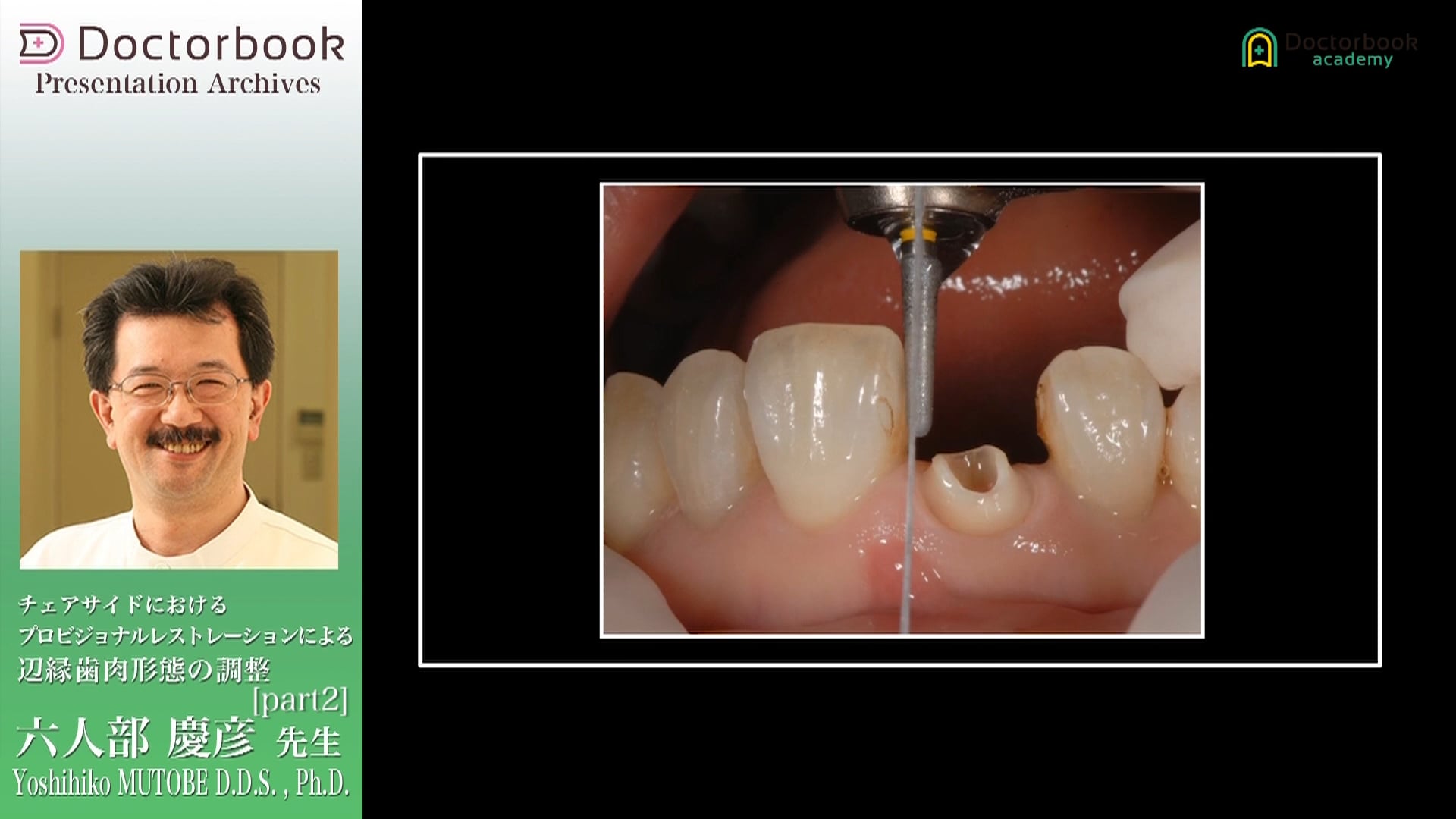 チェアサイドにおけるプロビジョナルレストレーションによる辺縁歯肉形態の調整 #2