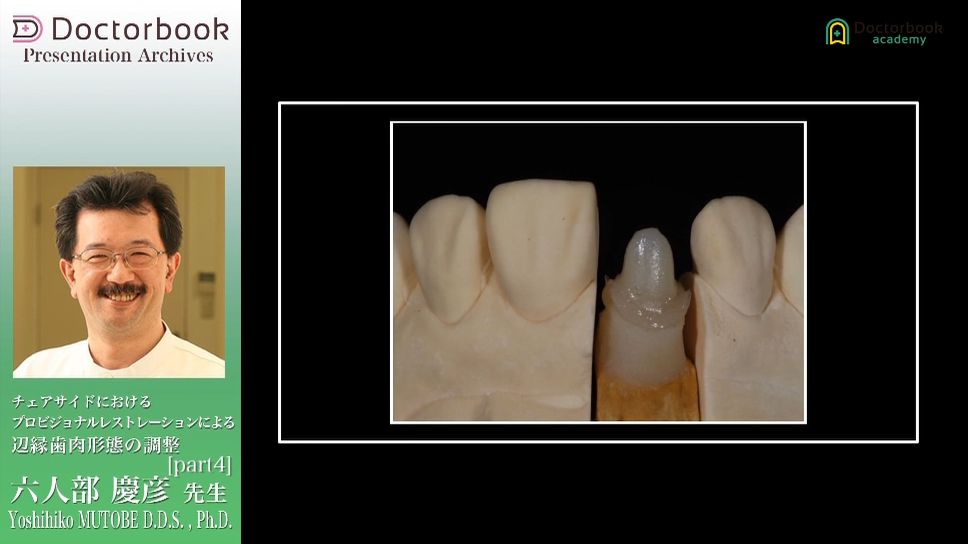 チェアサイドにおけるプロビジョナルレストレーションによる辺縁歯肉形態の調整 #4
