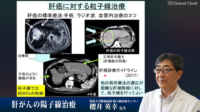 櫻井 英幸先生：肝がんの陽子線治療 Part1
