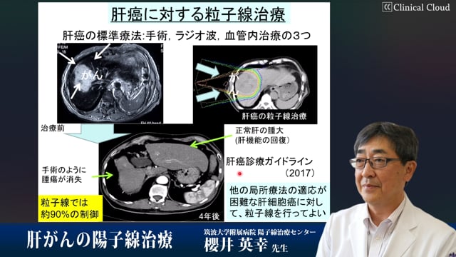 肝がんの陽子線治療 Part1