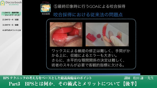 BPSとは何か、その術式とメリットについて（後半） #3 