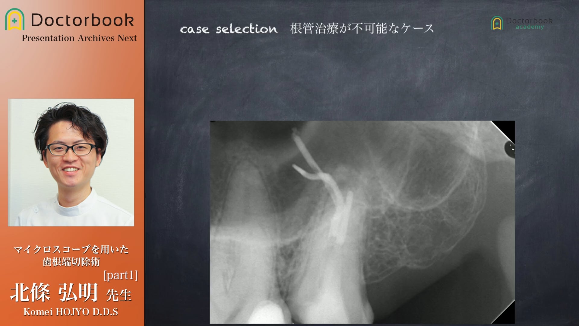 #1 歯根端切除の必要性と成功率