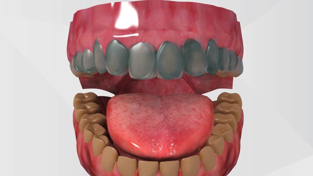 Animated Dental Videos | 3D Dental Animations | Dental Implant Video  Animation