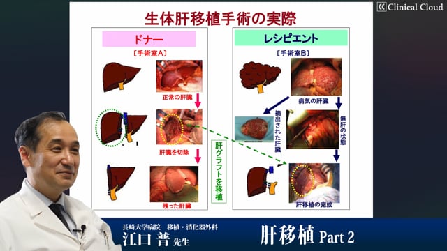 肝移植 Part2