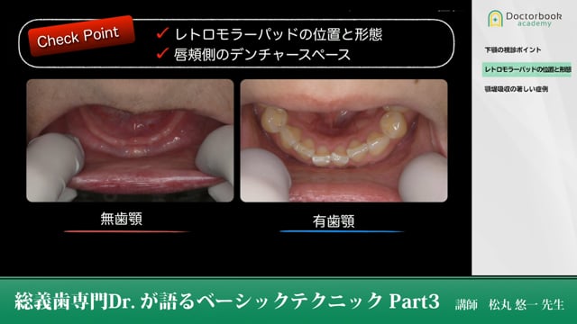 総義歯専門Drが語る「ベーシックテクニック」松丸悠一 - その他