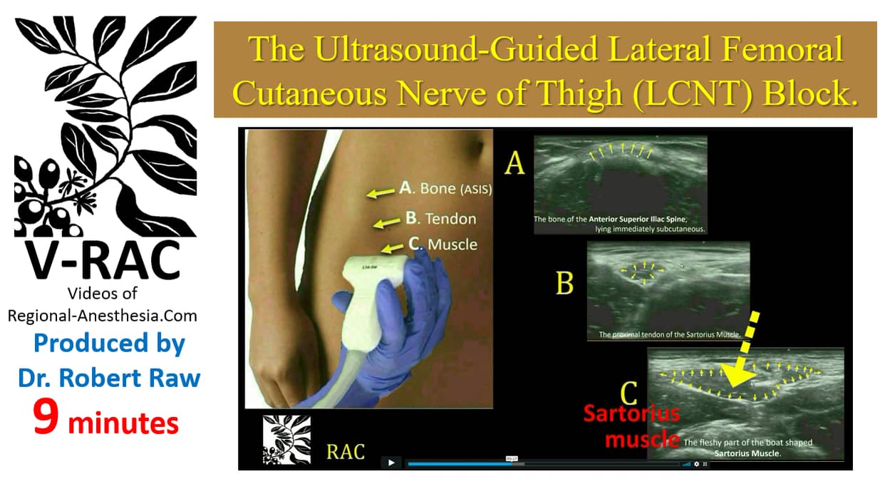 RR10 Lateral Cutaneous Femoral Nerve of Thigh block - ultrasound guided ...