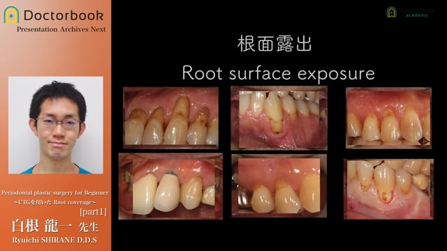 Periodontal plastic surgery for Beginner 〜CTGを用いたRoot coverage〜