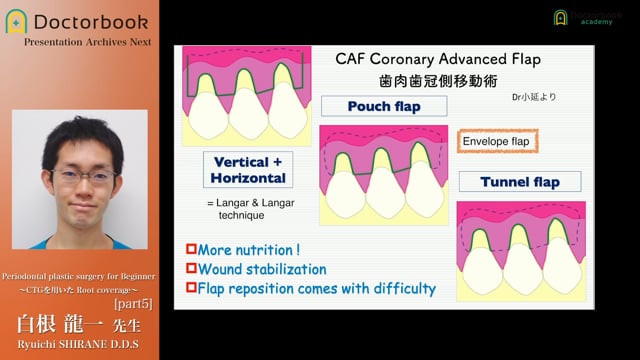 #5 CAF 歯肉歯冠側移動術