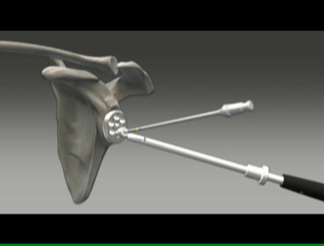 Exactech Shoulder - Equinoxe Reverse Shoulder Operative Technique Video ...