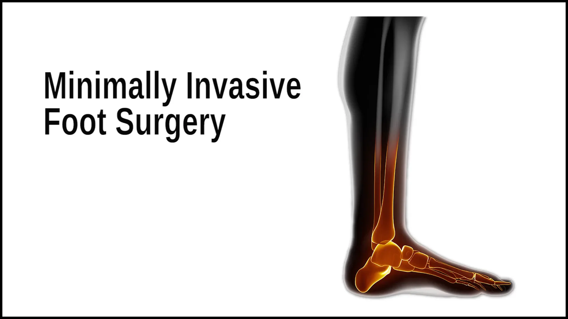 Minimally Invasive Surgery Foot Surgeon Temple Hill Clinton MD Burton J. Katzen DPM